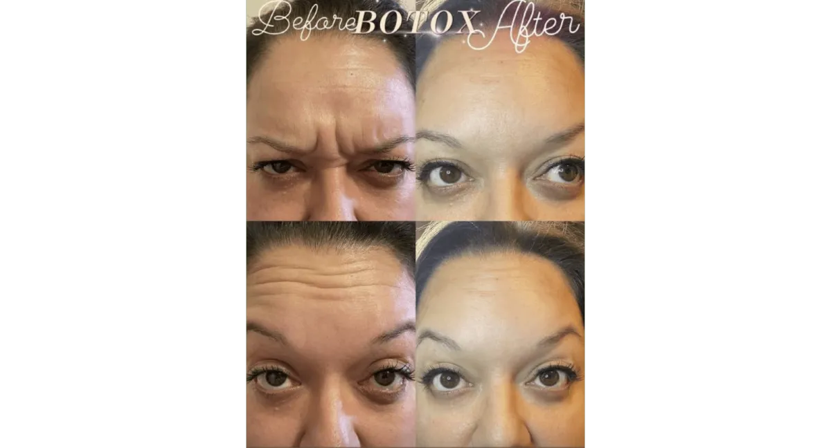 Effortless Rejuvenation: Botox & Fillers for a Youthful, Natural Look
